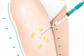 大腿抽脂能瘦多少？分为这几种情况图片