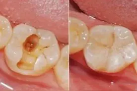 补完牙后，千万别大意。出现以下问题需要马上就医图片