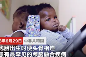 意大利成功完成双胞胎连头女婴头颅分离手术 或为世界首例图片