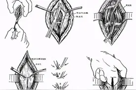 切开显露时该注意什么？图片