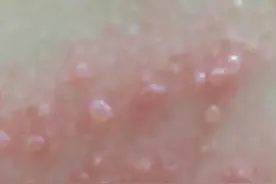 “带状疱疹”的有效治疗方法图片