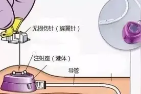 长期输液治疗患者康复的“港湾” ——聊城市二院两腺外科开展输液港一周年纪实图片