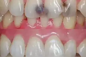 蛀牙后为什么要及时补牙？这些理由够不够图片
