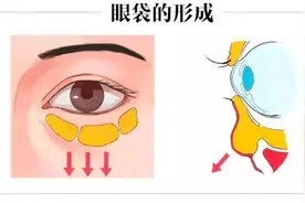 眶隔释放去眼袋为何如此受青睐？原因原来不仅仅是这样图片