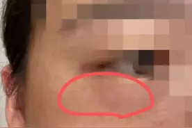 只因一条小虫，女子差点毁容！看完后怕…图片