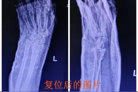 雨天路滑，北海一68岁妇女骑自行车跌倒致左手骨折图片