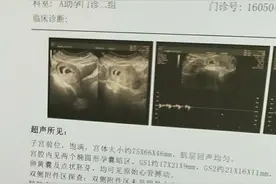 双胞胎试管婴儿受孕成功后的孕期分享（二）图片