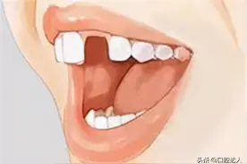 门牙缺了一颗怎么补，是做烤瓷牙还是种植牙？图片