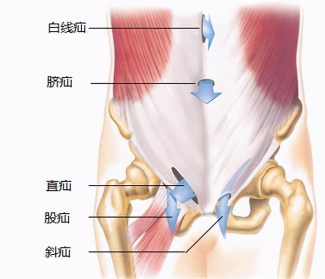 腹股沟疝气症状是什么（当心）