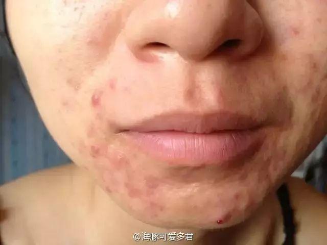 毛周角化症用郁美净儿童霜