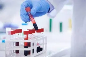 PSA检测，科学评价不容易图片