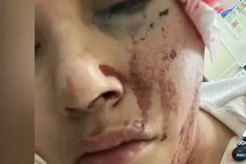 女子被洛杉矶警察橡皮子弹打破脸，索赔$1000万图片