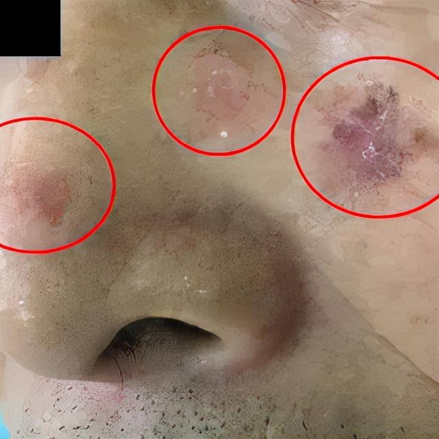 日光性角化病自己能好吗