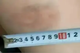 全班被打！体育女教师挨个抽打54名学生，有人伤痕达10厘米图片