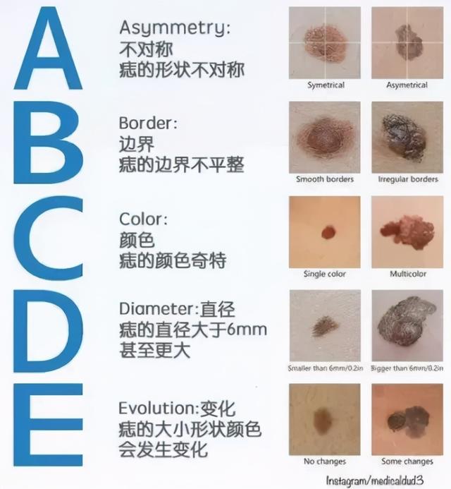 混合痣表皮角化不全