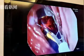 和妻子赌气 男子吞下打火机！3天后才想到去医院图片
