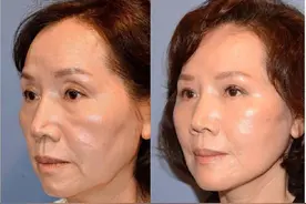 想要逆龄5-8岁，这些医美项目不能少（医生经验总结）图片