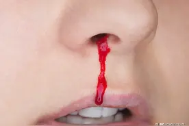 无缘无故流鼻血？以下一些健康问题，医生希望你一定要明白图片