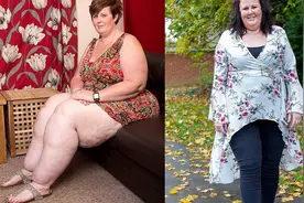 英国大象腿女人腿比你腰粗！腿粗91厘米吸脂72升略显正常视频封面