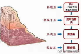 胃穿孔要做手术吗图片