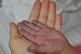 心脏不好指甲会有什么特征？听心血管医生讲图片