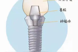 「牙齿那些事儿」No.67丨牙齿也能“种”出来？这有份种植牙攻略图片