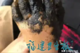 触目惊心！三明一男童被烟花炸伤，错误急救可能危及生命！元宵到了，千万警惕图片