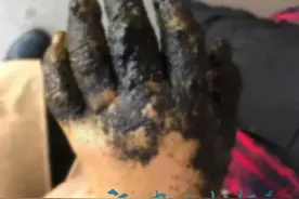 触目惊心！三明一男童被烟花炸伤，错误急救可能危及生命！元宵到了，千万警惕图片