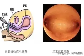 【齐鲁小科普】什么是宫腔镜检查？图片