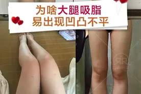 为啥大腿吸脂易出现凹凸不平？图片
