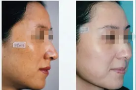 女性的嫩肤救星——光子嫩肤术，“神奇之处”在哪儿？图片