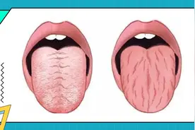 舌头有裂纹，主要是这6个原因造成的，中医6个小方可以治疗图片