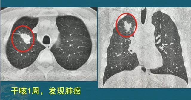 非角化型鳞癌胸腺