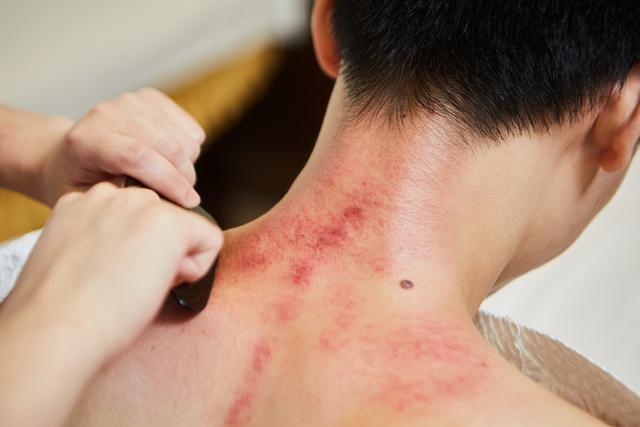 鸡皮肤能刮痧治好吗