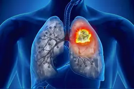 茄子是肺结节的“发物”？想要结节消散，哪些食物可常吃？图片