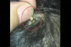 妈妈为女儿梳头发现“小米粒”，心急带娃检查，医生：幸好来得早图片