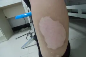 秋冬季白癜风逐渐稳定，是自愈还是伪装？图片