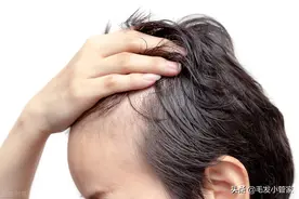 植发能让脱发区域正常生长出头发图片