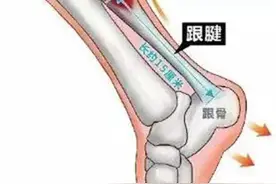 收藏 | 跟腱断裂诊疗策略图片