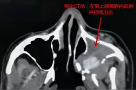 鼻出血控制不住，别怕，介入栓塞显奇效图片