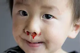 4岁男孩鼻子流血不止，爸爸“三个果断”救了孩子，医生：做得好图片