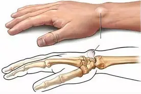 手腕突然长了一个小疙瘩，不用担心，可能是腱鞘囊肿，请看下文图片