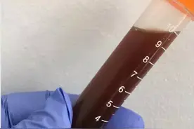 黄色尿液变黑了？细心的爸爸发现孩子尿液偷偷变色，查出罕见病图片