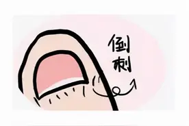 手上倒刺别乱撕，小心进医院图片