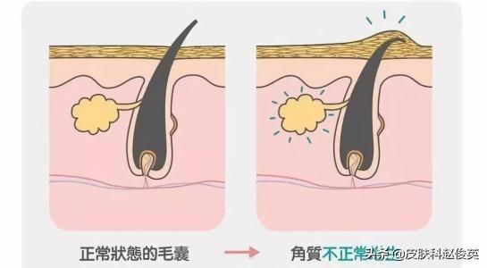 这几天熬夜手臂鸡皮疙瘩