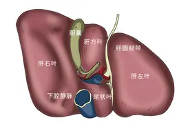 转氨酶高，一定是肝病？为啥转氨酶高到100多，身体却没症状？图片