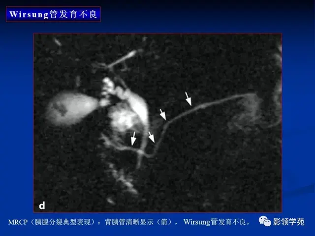 胰腺的解剖与常见变异