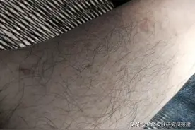鱼鳞病年龄大了能自愈吗？图片