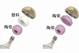 人工髋关节置换，该换一个金属的，陶瓷的，还是塑料的？图片