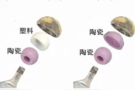 人工髋关节置换，该换一个金属的，陶瓷的，还是塑料的？图片